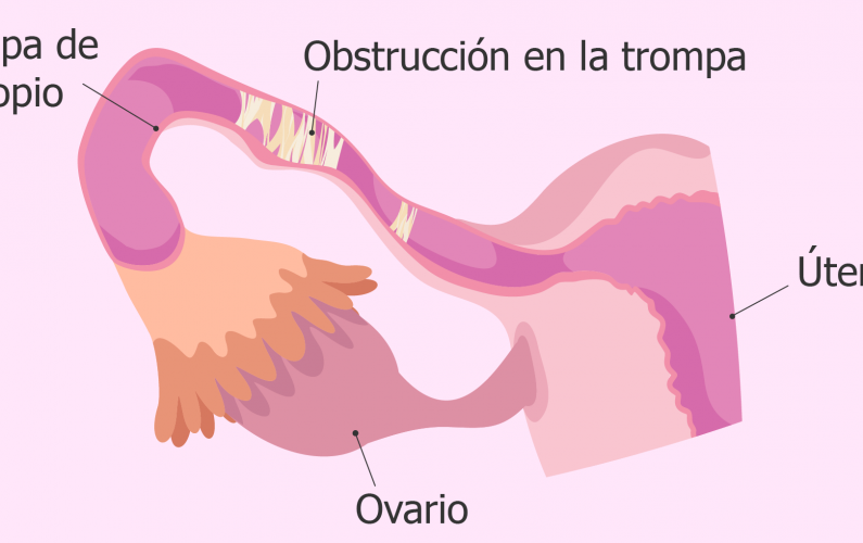 Ilustración de las trompas de Falopio
