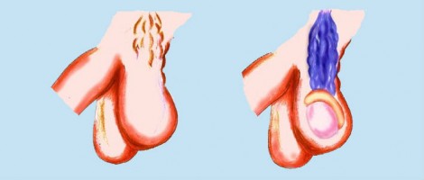 Ilustración de varicocele
