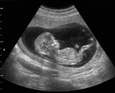 Ultrasonido de un bebé en desarrollo